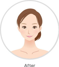 美容鍼 施術後