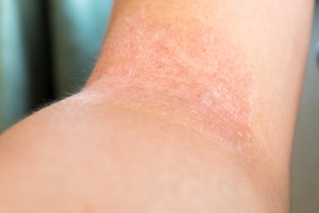 腕のアトピー性皮膚炎