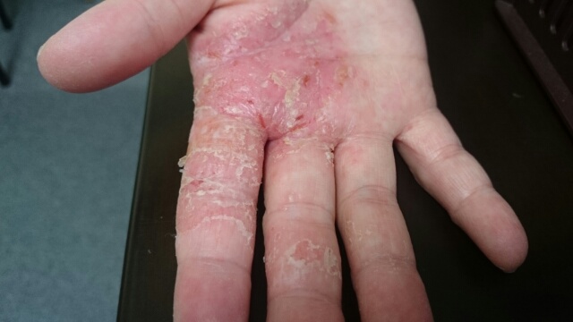 カンジタによる手湿疹